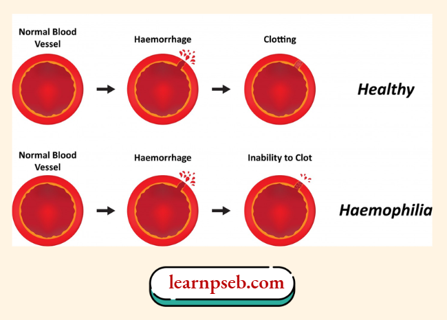 PBSE Solutions Class 10 Biology Chapter 3 Haemophilia Is An X-Linked Disorder Characterized By The Inability To Properly Form Blood Clots